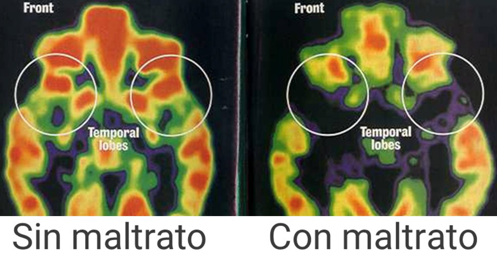 Los efectos del acoso escolar en el cerebro infantil